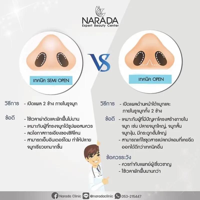 การเสริมจมูกเทคนิคOpenกับSemi-Open ต่างกันอย่างไร