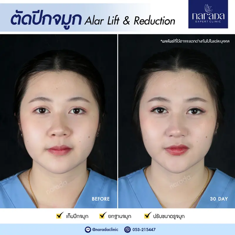 ปรับปีกจมูกให้เข้ากับใบหน้า ที่ นารดาคลินิก