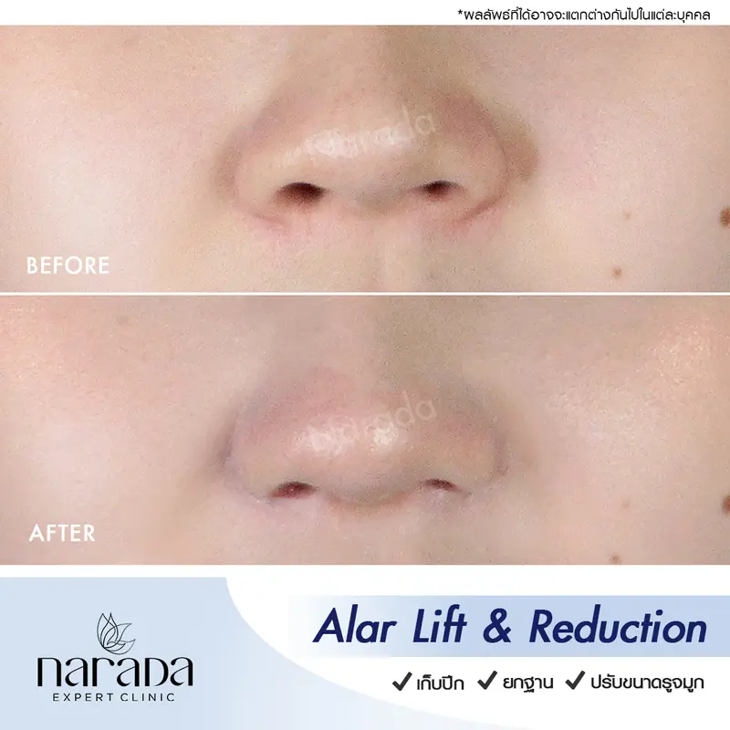 ล็อคปีกจมูกให้ได้ทรงสวย ด้วย Alar Lift & Reduction ที่ นารดาคลินิก