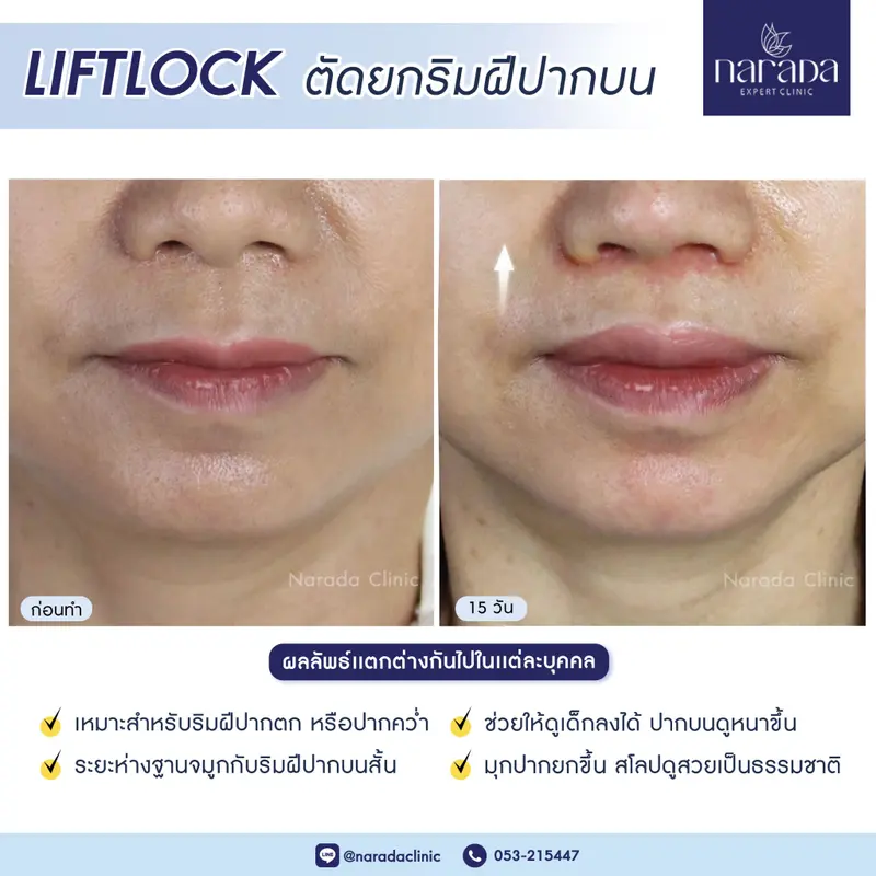 ศัลยกรรมยกริมฝีปากถาวร ซ่อนแผลขอบปีกจมูก