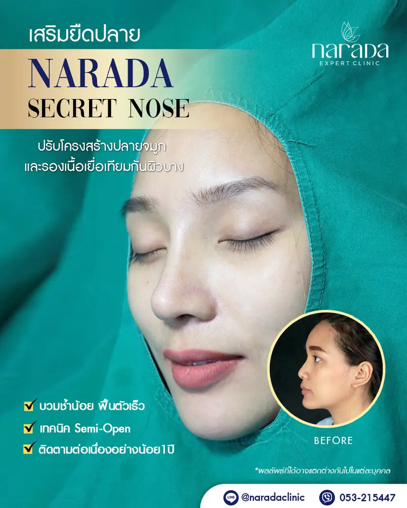 ปรับเปลี่ยนลุคให้กับใบหน้า ด้วยการเสริมจมูกเทคนิค Semi-Open รองเนื้อเยื่อเทียม