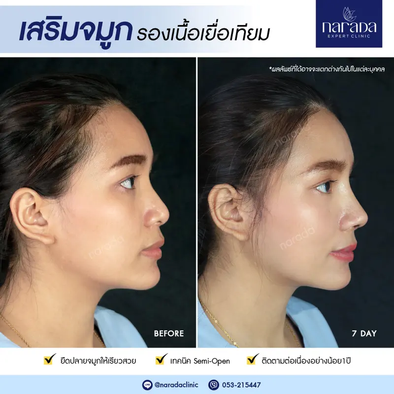 7 วัน ปังไม่ไหว เสริมจมูก Semi-Open รองเนื้อเยื่อเทียม 