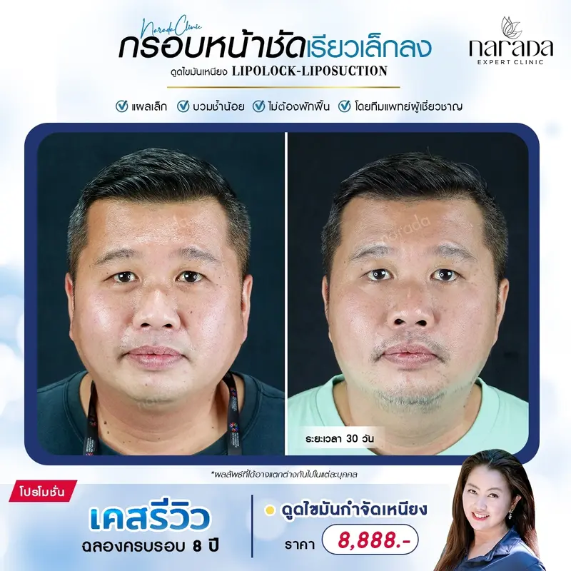 กำจัดเหนียง ให้เห็นกรอบหน้าที่ชัดขึ้น ด้วยโปรแกรมดูดไขมันเหนียง ที่นารดาคลินิก