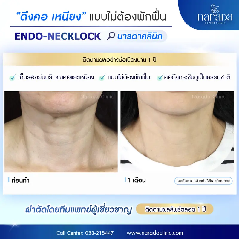 ดึงชั้นคอ แบบไม่ต้องพักฟื้น ที่ นารดาคลินิก
