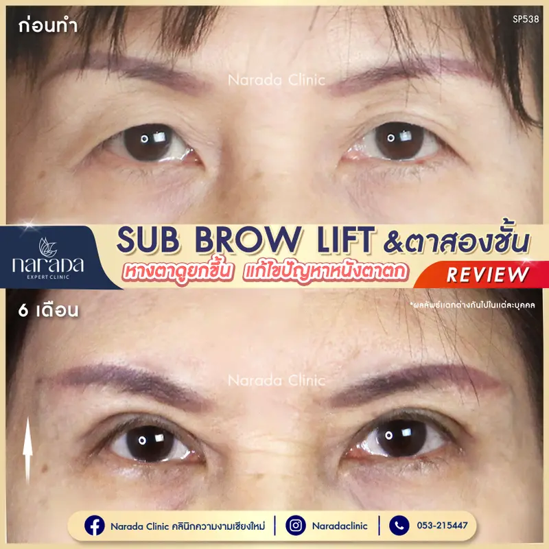 กู้คืนชั้นตาที่ตก ให้กลับมากลมโตเหมือนเดิม ที่ นารดาคลินิก