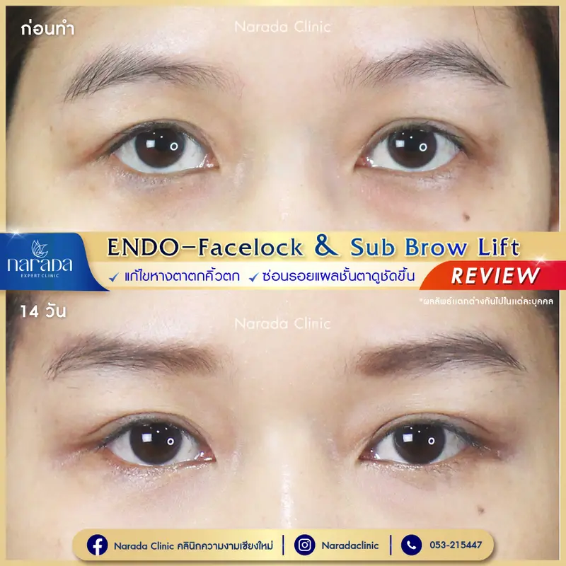 เผยดวงตาให้ดูสดใส ด้วยEndo-Facelock ที่ นารดาคลินิก