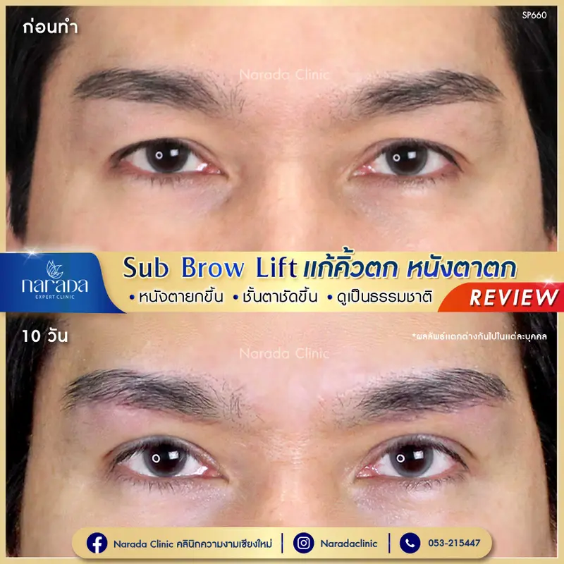 เทคนิคซ่อนรอยแผล Sub Brow Lift แก้คิ้วตก หนังตาตก ที่ นารดาคลินิก