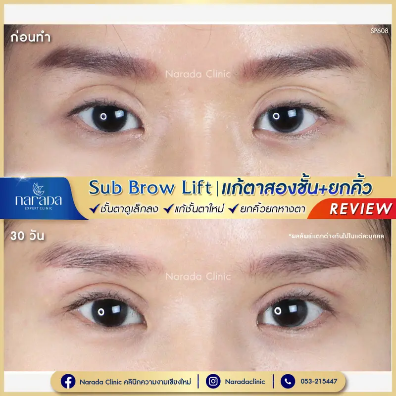 ชั้นตาเดิมใหญ่ดูหนา และตาปรือ แก้ด้วย Sub Brow Lift & แก้ตาสองชั้น+ยกคิ้ว ที่ นารดาคลินิก