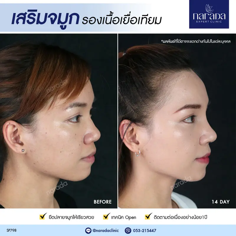 เสริมจมูก เพิ่มให้ใบหน้าดูหวานขึ้น ด้วยการเสริมจมูก เทคนิค Open