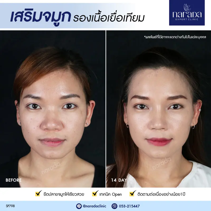 เสริมจมูก เพิ่มให้ใบหน้าดูหวานขึ้น ด้วยการเสริมจมูก เทคนิค Open