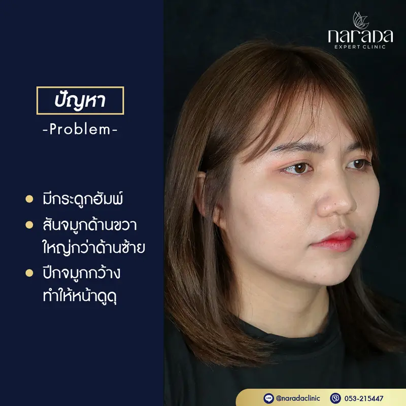 เสริมจมูก Semi-Open รองเนื้อเยื่อเทียม+ตักปีกจมูก