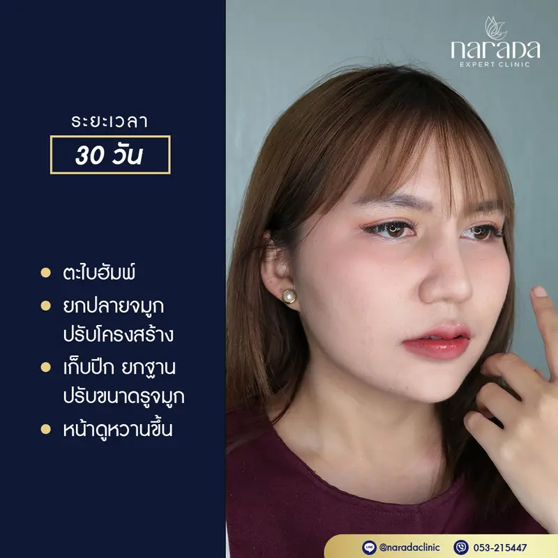 เสริมจมูก Semi-Open รองเนื้อเยื่อเทียม+ตักปีกจมูก