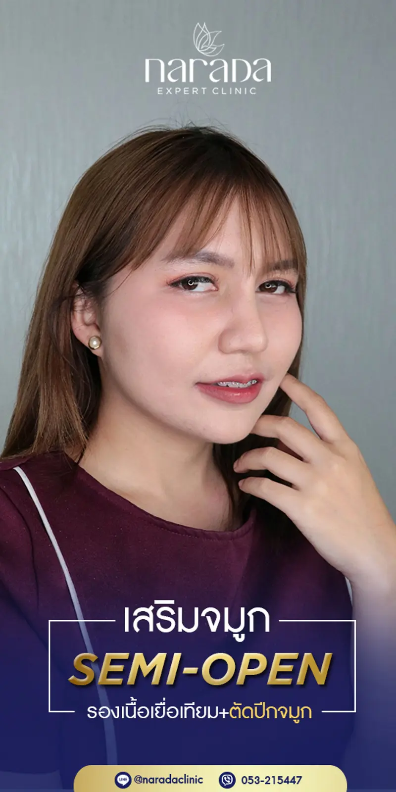 เสริมจมูก Semi-Open รองเนื้อเยื่อเทียม+ตักปีกจมูก