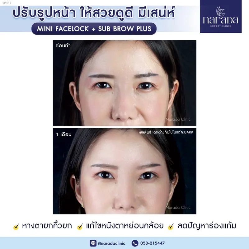 ลดปัญหาหนังตาหย่อนคล้อย ที่ นารดาคลินิก