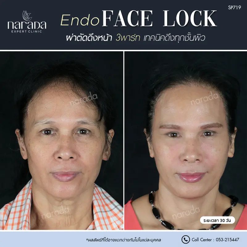 กู้ผิวให้ตึงกระชับ ด้วย Endo Facelock 3 part ที่ นารดาคลินิก