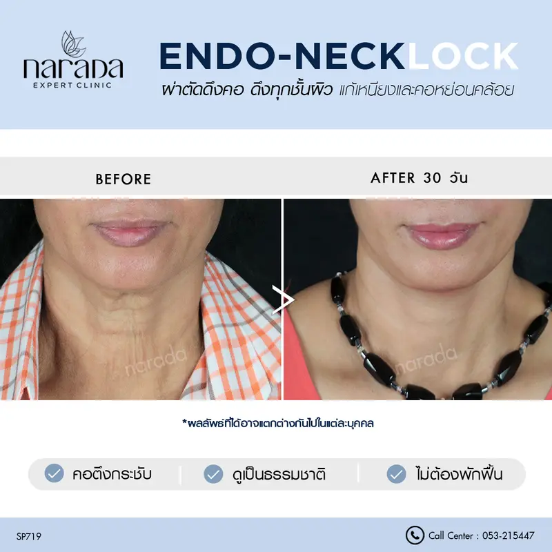 แก้รอยเหี่ยวย่นบริเวณคอ ที่ นารดาคลินิก