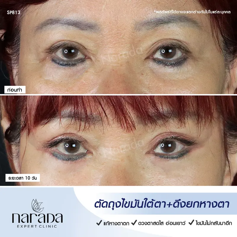 ถุงใต้ตา มักจะมาพร้อมกับอายุที่มากขึ้น แก้ด้วยตัดถุงไขมันใต้ตา ที่ นารดาคลินิก