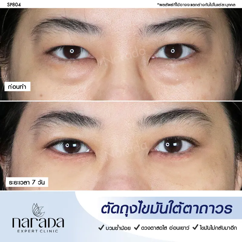 อายุน้อยแต่มีถุงใต้ตา แก้ไขที่ นารดาคลินิก