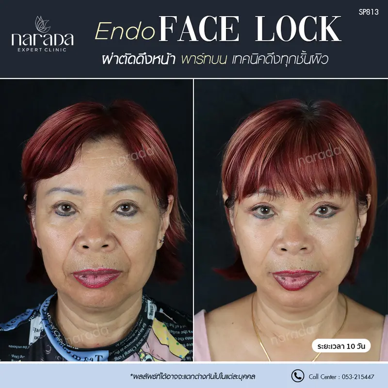 ร่องแก้มลึก+ถุงใต้ตา ที่เกิดจาดอายุที่มากขึ้น แก้ไขที่ นารดาคลินิก