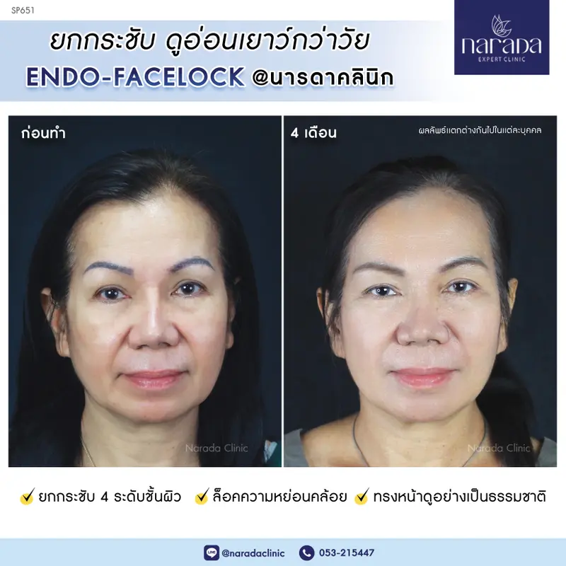 ย้อนวัย ล็อคความหย่อนคล้อย ที่ นารดาคลินิก