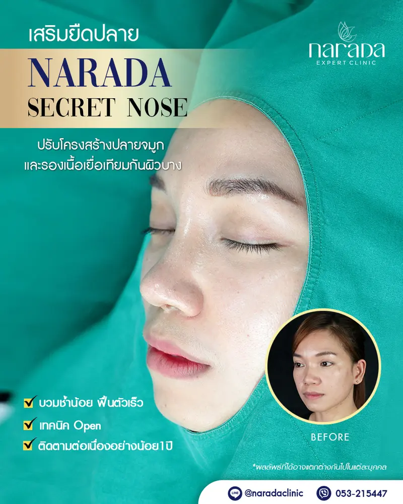ดั้งโด่ง พุ่งสวย ที่ นารดาคลินิก