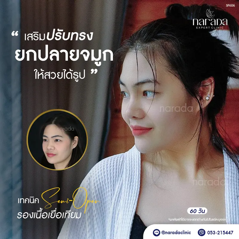 หน้าสวย จมูกชัด ที่ นารดาคลินิก