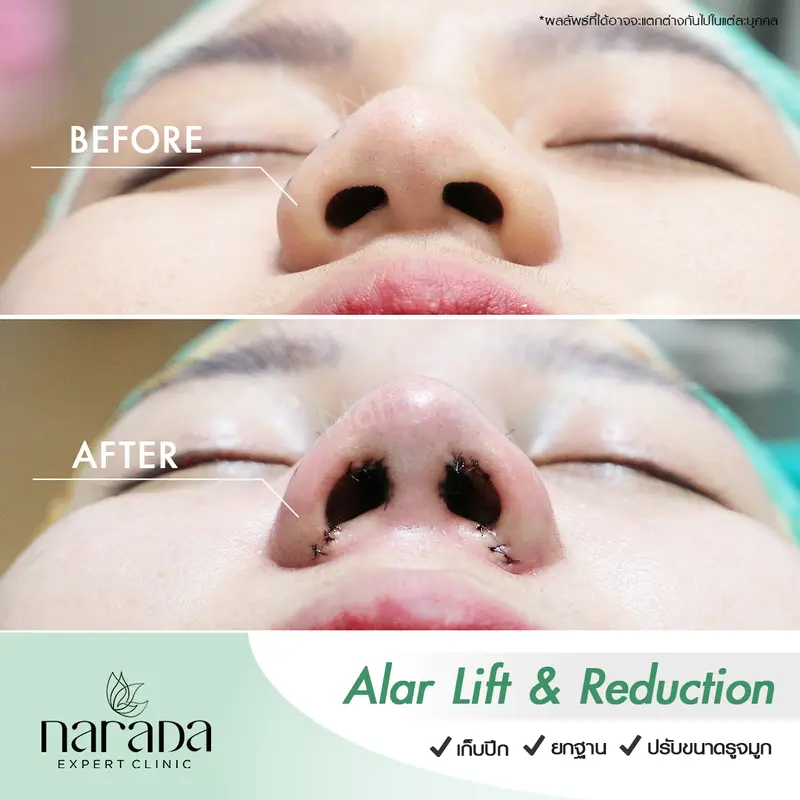 ตัดปัญหาปีกจมูกใหญ่ แก้โดย Alar Lift & Reduction ที่ นารดาคลินิก