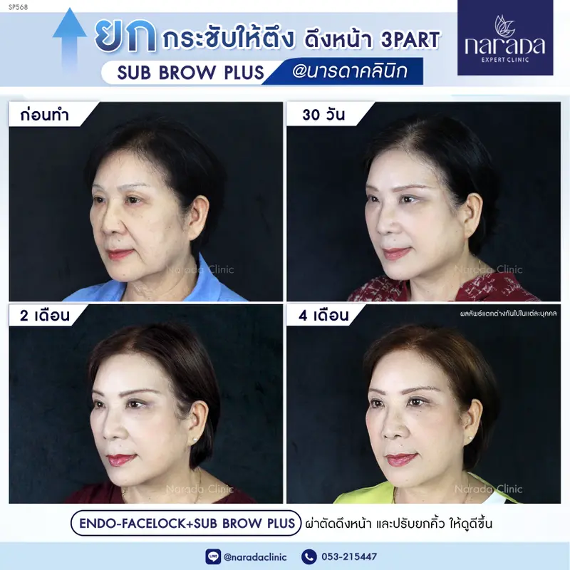 ยกกระชับใบหน้า ที่ นารดาคลินิก