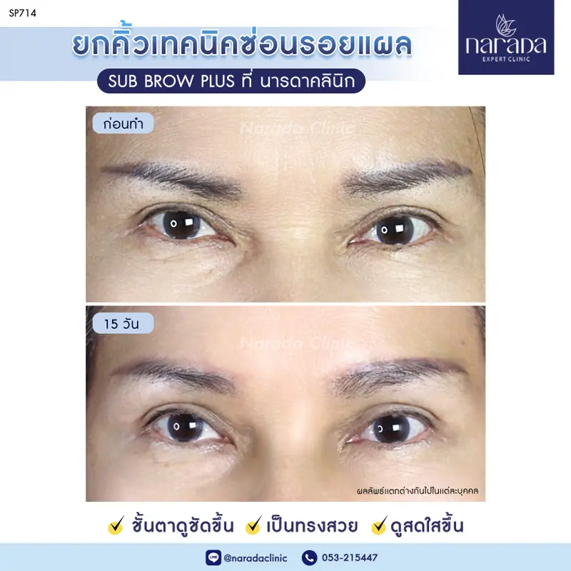 ซ่อนรอยแผลใต้คิ้ว ที่ นารดาคลินิก