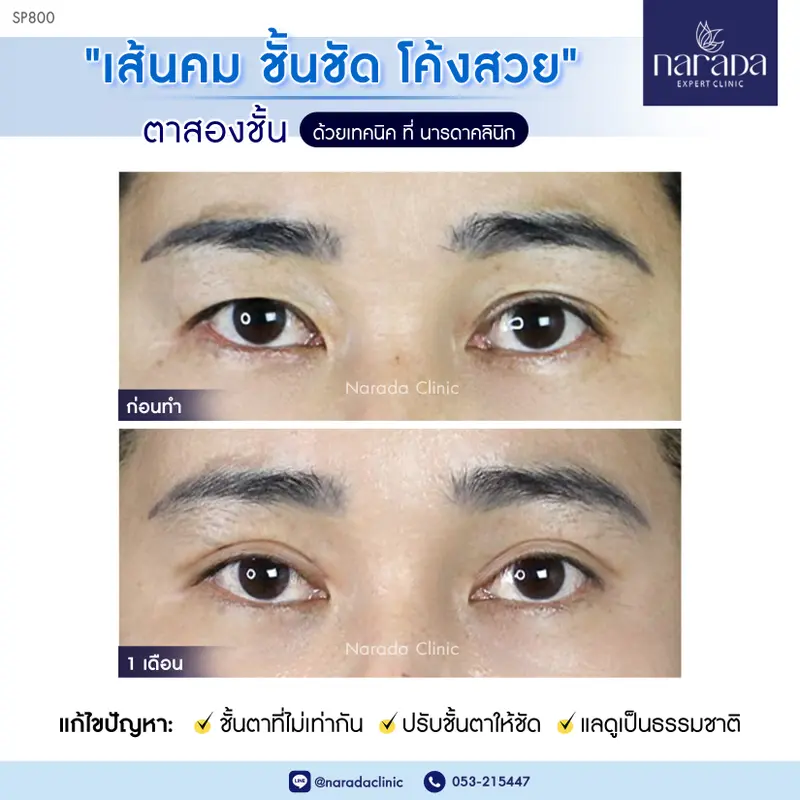 ดวงตากลมโต เส้นคม ชั้นชัด ที่ นารดาคลินิก