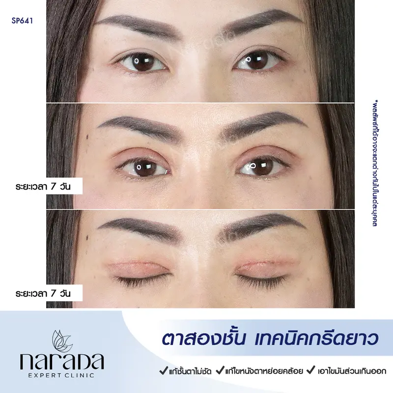 โชว์ชั้นตา ที่ชัดมากขึ้น ที่ นารดาคลินิก