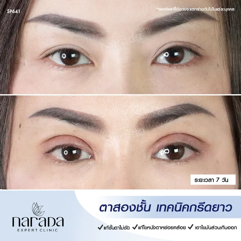 ดวงตาสดใส กลมโต เทคนิคกรีดยาว ที่ นารดาคลินิก