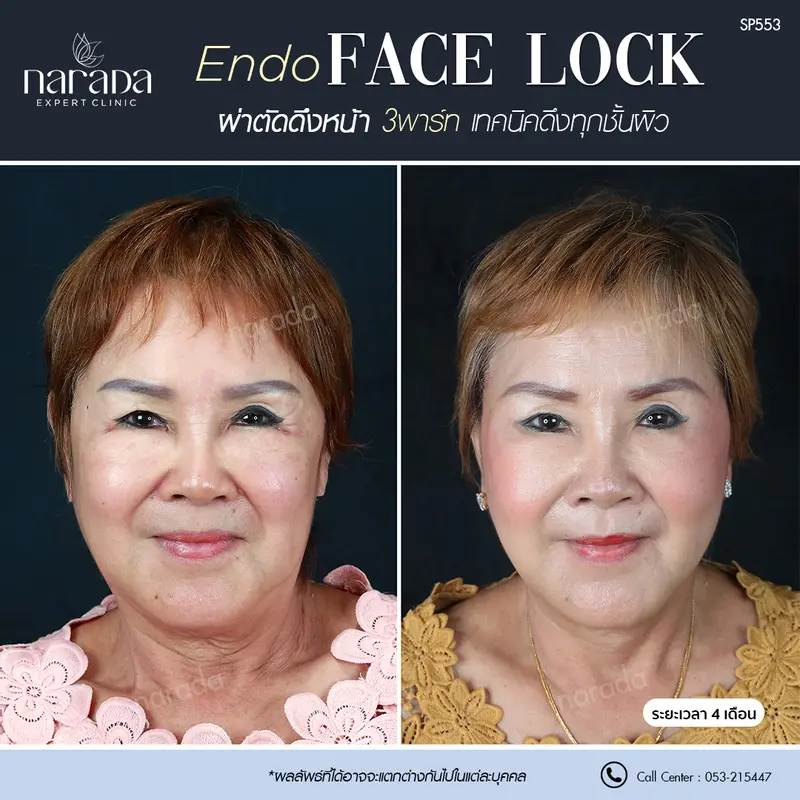 ดึงหน้าให้ผิวกระชับ ที่ นารดาคลินิก