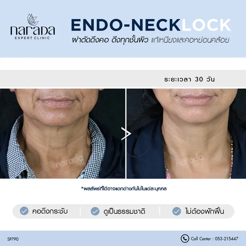 แก้เหนียงและคอหย่อนคล้อย ที่ นารดาคลินิก