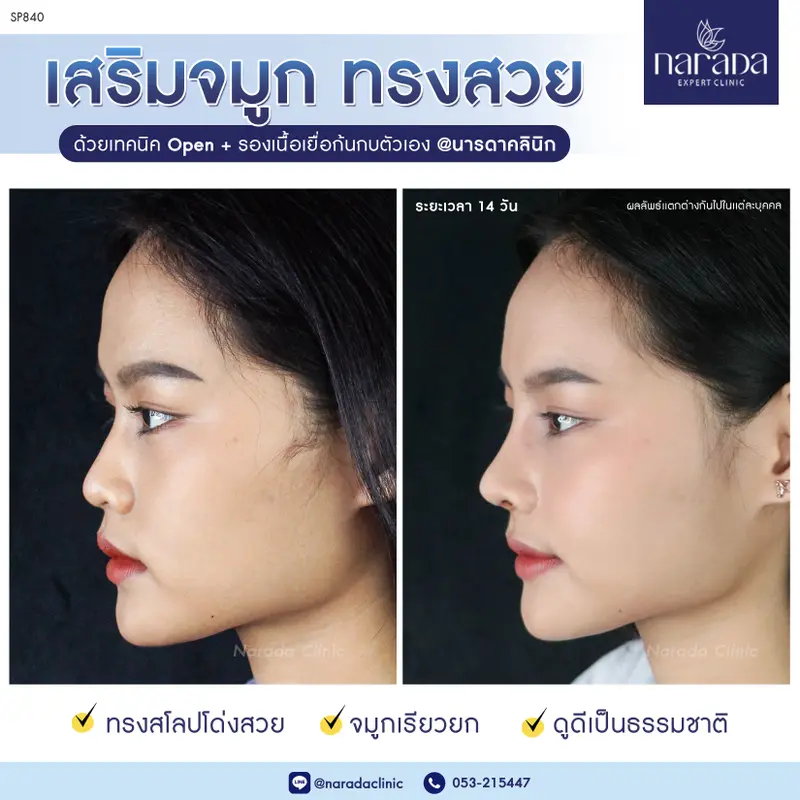 เพิ่มมิติให้กับใบหน้า ด้วยจมูกทรงสวย ที่ นารดาคลินิก