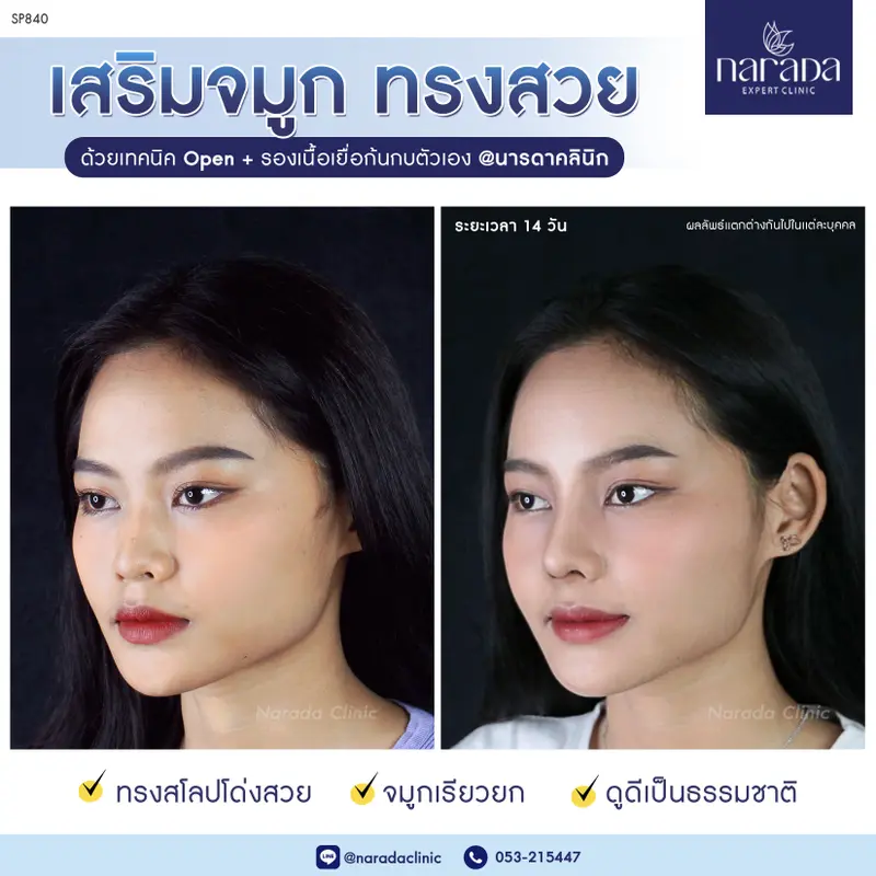 เพิ่มมิติให้กับใบหน้า ด้วยจมูกทรงสวย ที่ นารดาคลินิก