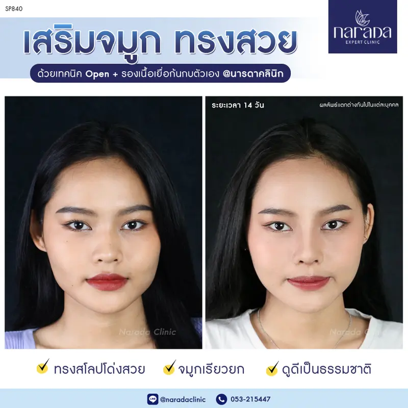 เพิ่มมิติให้กับใบหน้า ด้วยจมูกทรงสวย ที่ นารดาคลินิก