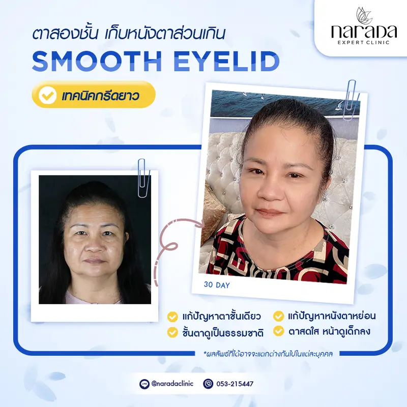 เก็บหนังตาส่วนเกิน ที่ นารดาคลินิก