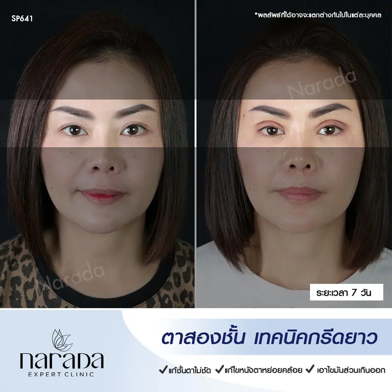 ทำตาสองชั้น เทคนิคกรีดยาว ที่ นารดาคลินิก