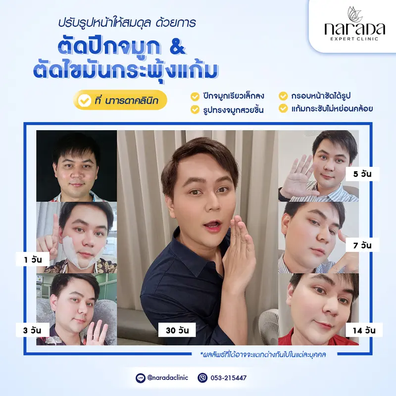 ลาขาด ไขมันกระพุ้งแก้ม ที่ นารดาคลินิก