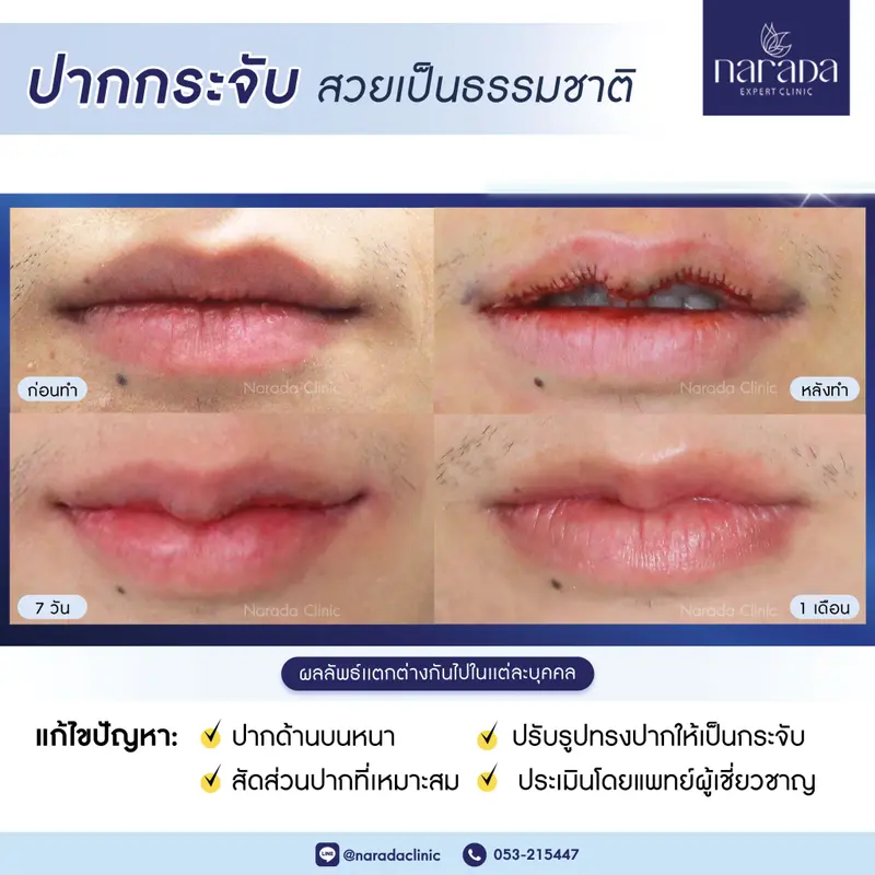 ปรับเปลี่ยนรูปทรงปาก ให้สวยมากยิ่งขึ้น ด้วยการทำปากกระจับ ที่ นารดาคลินิก