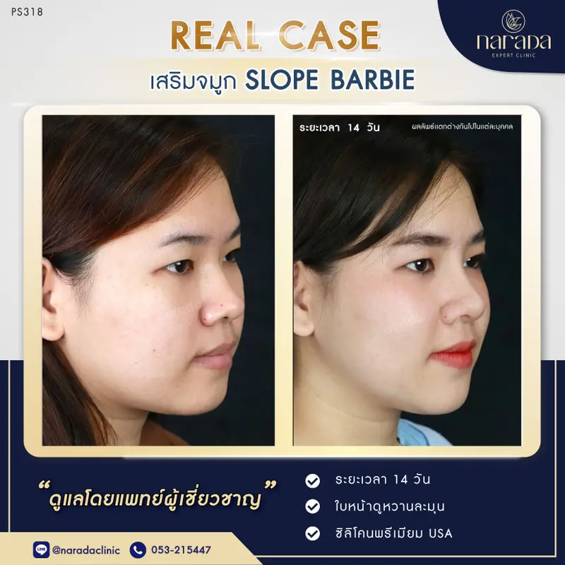 ทรงจมูกสโลปสวย ด้วยทรง Slope Barbie ที่ นารดาคลินิก