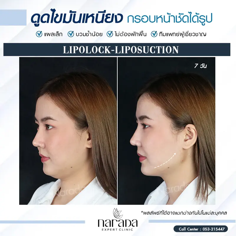 กรอบหน้าชัด แผลเล็ก ที่ นารดาคลินิก