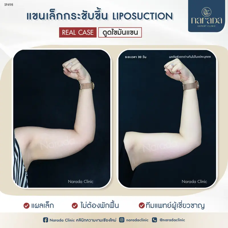 ยกแขนอย่างมั่นใจ ที่ นารดาคลินิก