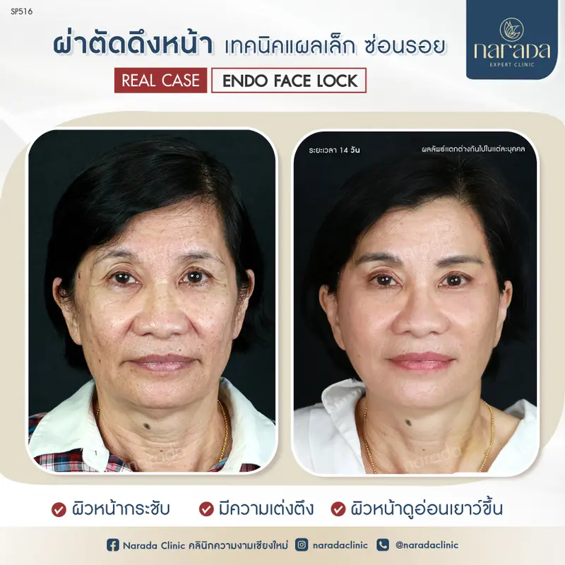 คืนสภาพผิวให้กระชับ ที่ นารดาคลินิก