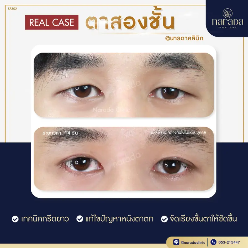 เพิ่มเสน่ห์ให้กับดวงตา ที่ นารดาคลินิก