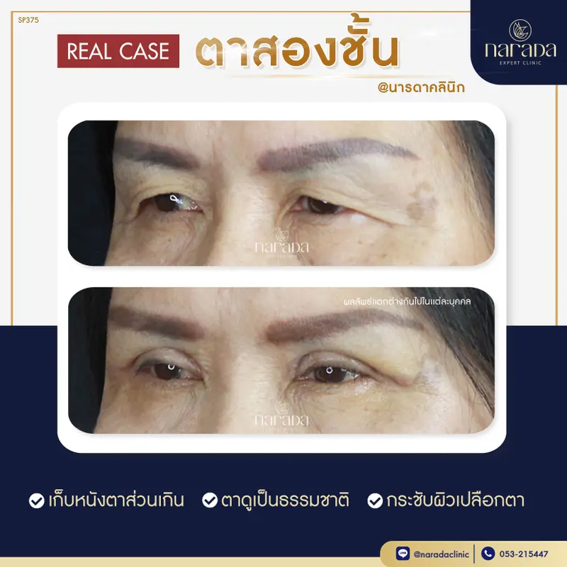 บอกลาปัญหา ชั้นตามีหลายชั้น ชั้นตาไม่เท่ากัน ทำให้ดูไม่สดใส