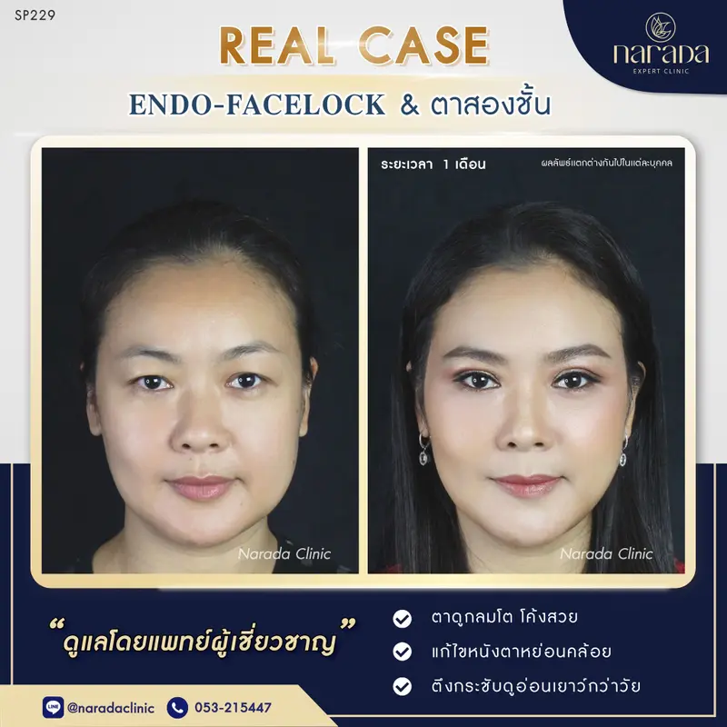 ล็อคความเต่งตึง ดูอ่อนเยาว์กว่าวัย เผยชั้นตาชัดขึ้น ENDO-FACELOCK & ตาสองชั้น ที่ นารดาคลินิก