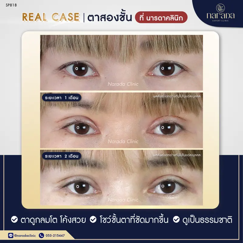 ชั้นตาโค้งสวย ชัดขึ้นอย่างเป็นธรรมชาติ ด้วยการทำ ตาสองชั้นเทคนิคกรีดยาว ที่ นารดาคลินิก