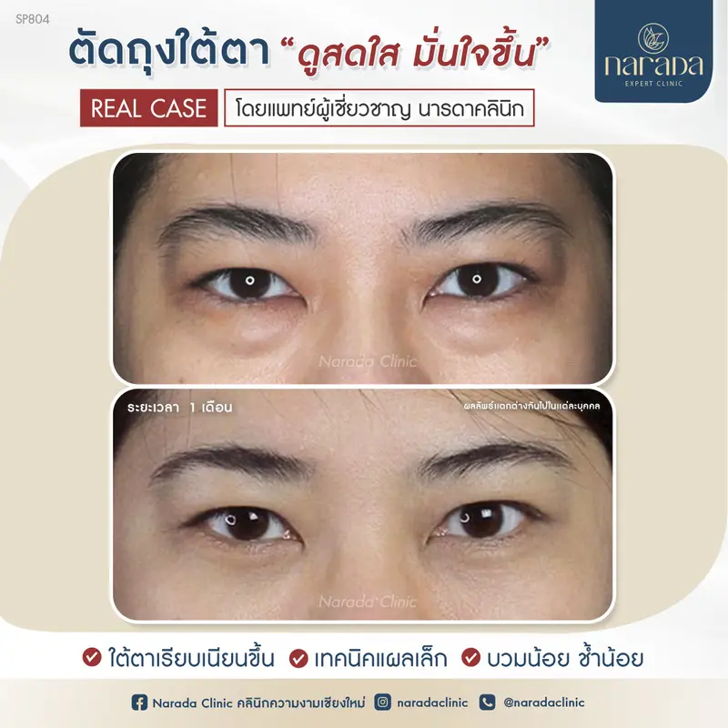 ใต้ตาดูสดใส เพิ่มความมั่นใจมากขึ้น ด้วยการ ตัดถุงใต้ตา ที่ นารดาคลินิก